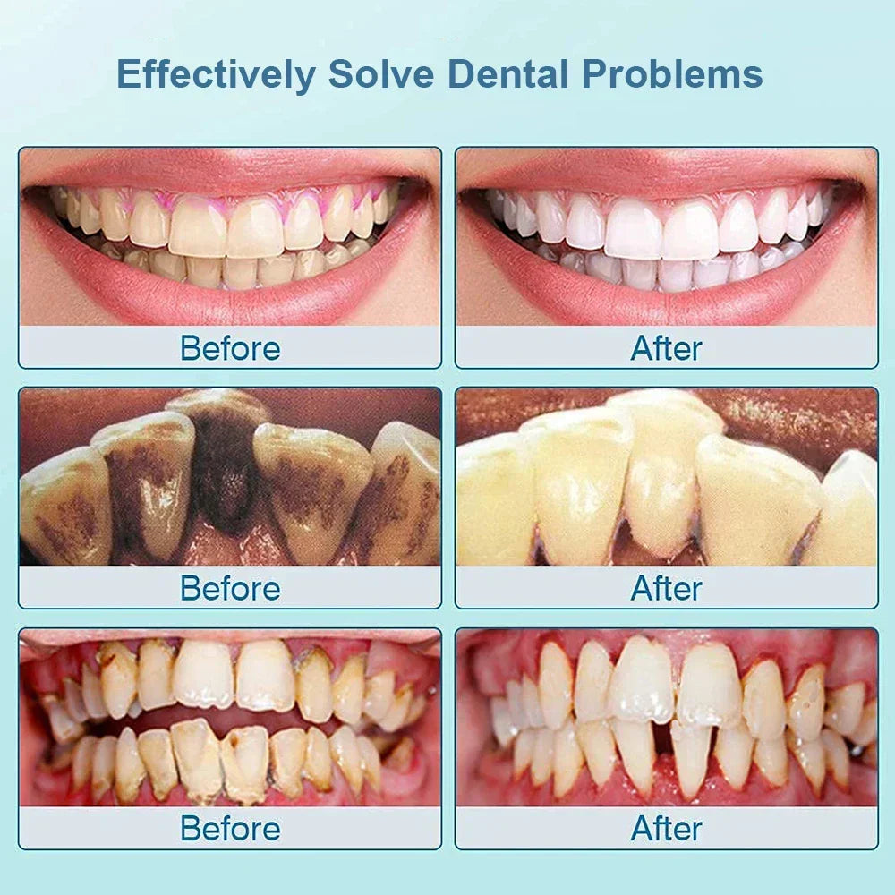 Ultrasone Tandenreiniger - SonicClean
