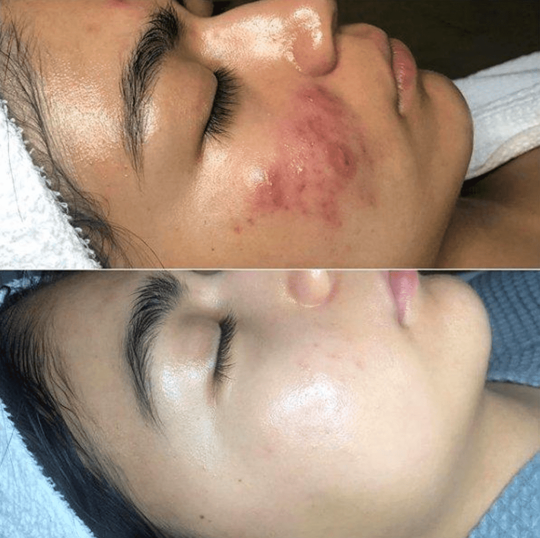 Huidtherapie met hoogfrequentie – GlowWave