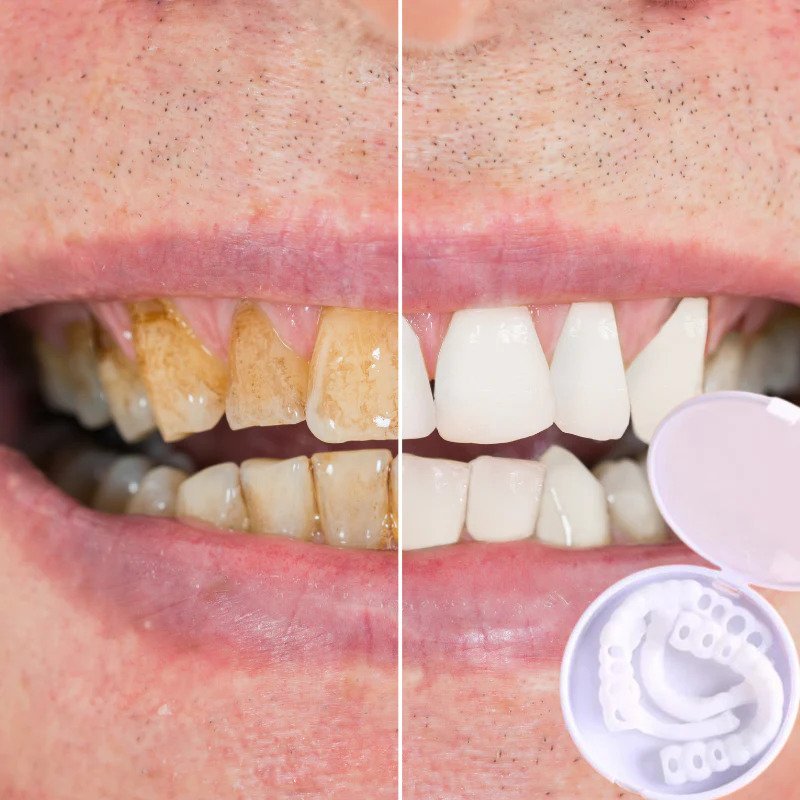 Klik-veneers | Flexibele pasvorm zonder lijm voor maaltijden en dagelijks gebruik