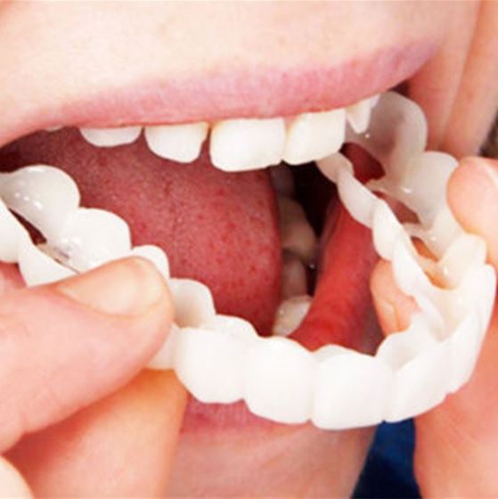Klik-veneers | Flexibele pasvorm zonder lijm voor maaltijden en dagelijks gebruik