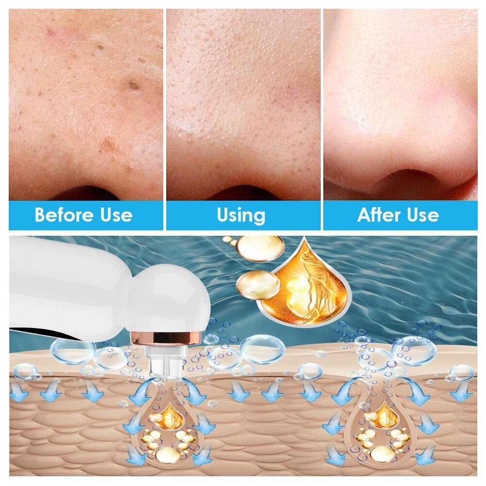 Mee-eter Verwijderaar en Hydrodermabrasie - HydraGlow - SkinzLine